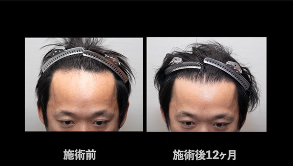 YouTuber二宮祥平さん 自毛植毛 体験記 12ヶ月偏_04