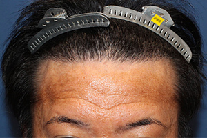 30代 男性 I.M.さん  生え際・前頭部 自毛植毛（MIRAI法） 2,300株（施術後）_2
