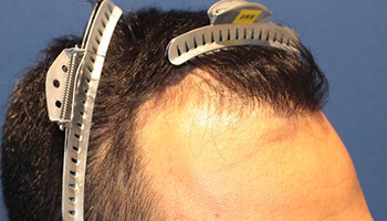 30代 男性 T.H.さん 生え際 自毛植毛（MIRAI法） 1,300株の症例（手術前）_02