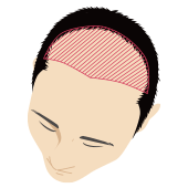 薄毛が広範囲の男性頭部のイラスト