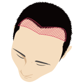 生え際が薄毛の男性頭部のイラスト