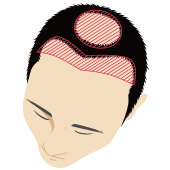 前頭部と頭頂部が薄毛の男性頭部のイラスト