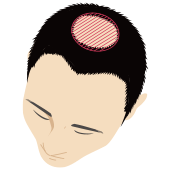 頭頂部が薄毛の男性頭部のイラスト