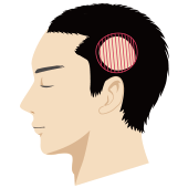 側頭部が薄毛の男性頭部のイラスト