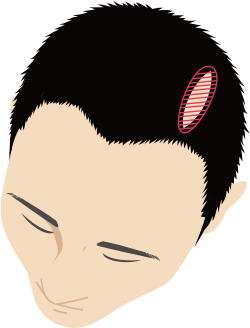 傷痕のイメージ